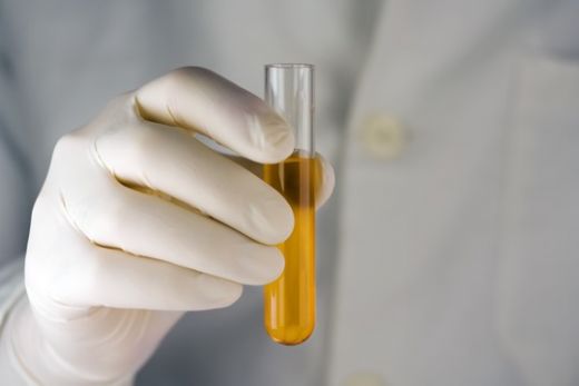 24 Saatlik İdrar Nasıl Toplanır?