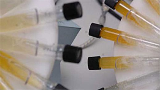 Beyaz İdrar Nedenleri?