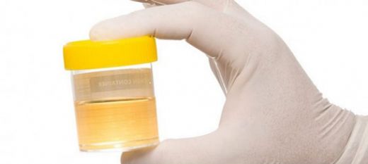 Bulanık İdrara Hangi Durumlar Sebep Olur?