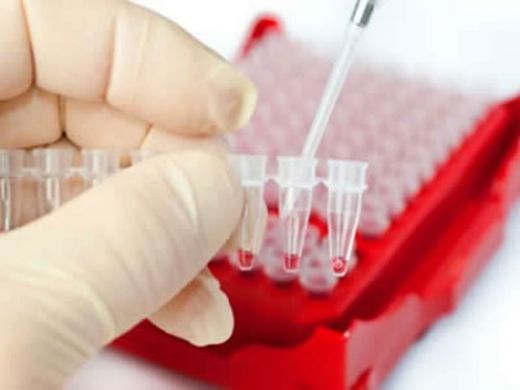 Eritrosit İdrar Tahlili Eritrosit İdrar Sebepleri