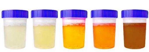 İdrar Analizi Nasıl Yapılır?