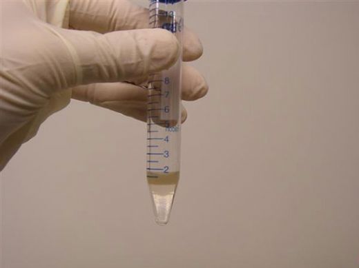 İdrar Damlaması Tedavisi