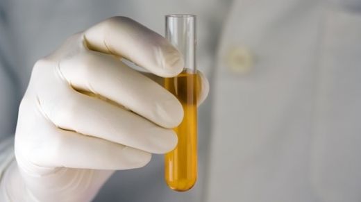 İdrar Dansitesi Belirtileri ve Tedavisi