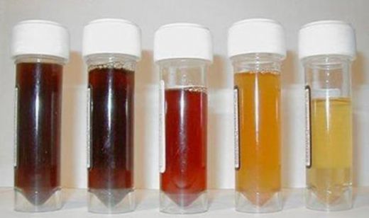 İdrar Kanaması Belirtileri ve Tedavisi