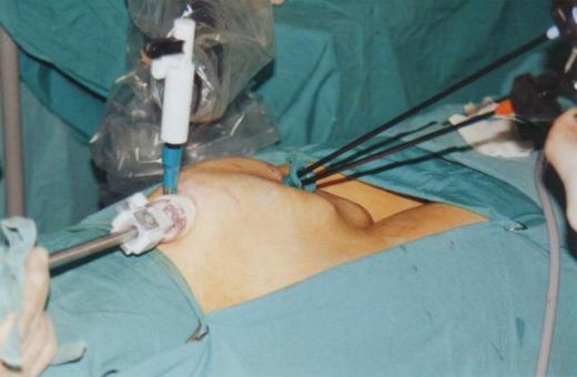 İdrar Kesesi Ameliyatı Riskleri ve Sonrası