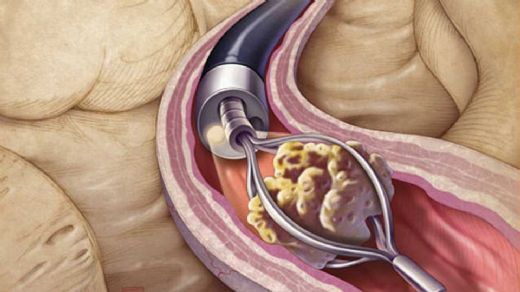 İdrar Yollarında Taş Teşhisi