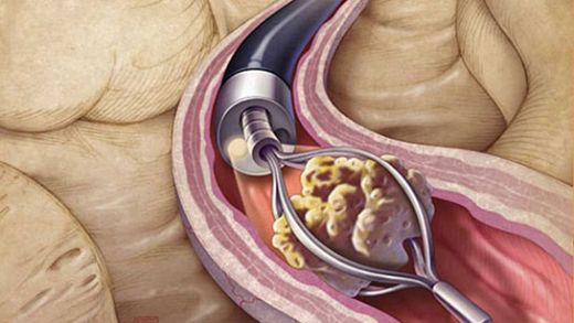 İdrar Yolu Kanaması Belirtileri ve Tedavisi