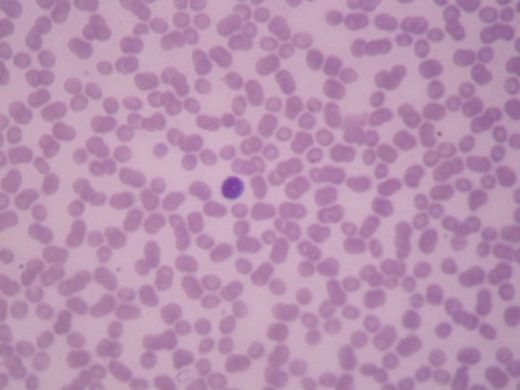 İdrarda Bakteri Belirtileri ve Tedavisi