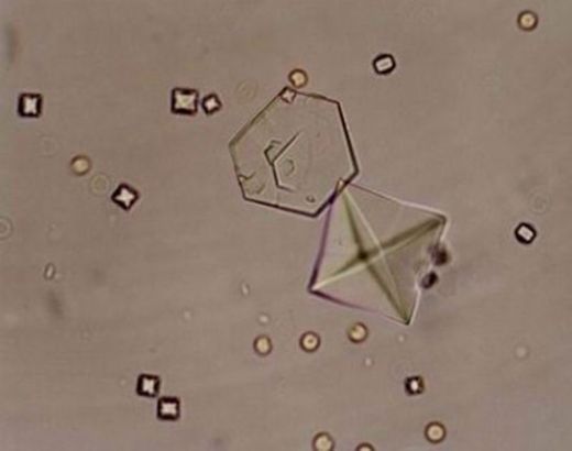 İdrarda Eritrosit Belirtileri ve Tedavisi