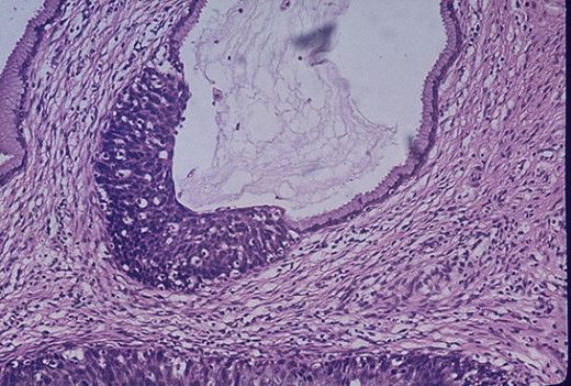 İdrarda Yassı Epitelin Olmasın Nedenleri