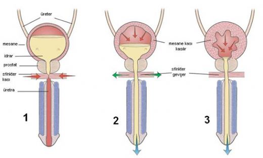 Mesanede İdrar Kalması Tedavisi